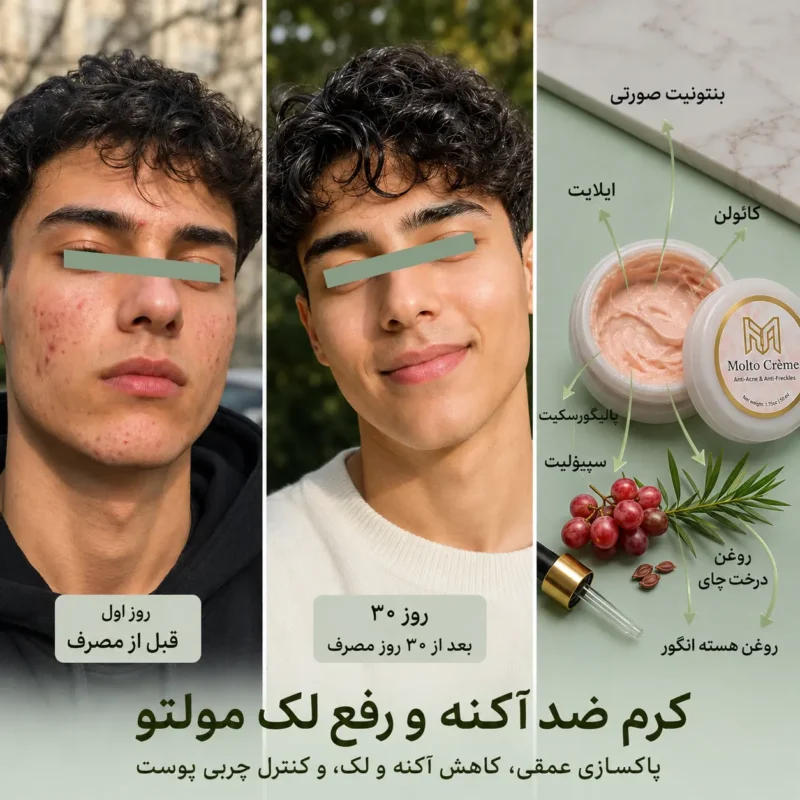نتیجه استفاده از کرم ضد آکنه و رفع لک مولتو کرم